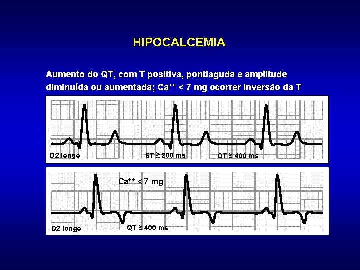 HIPOCALCEMIA Aumento do QT, com T positiva, pontiaguda e amplitude diminuída ou aumentada; Ca++