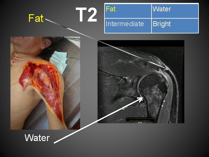 Fat Water T 2 Fat Water Intermediate Bright 