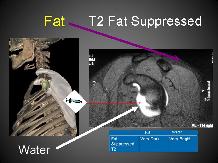 Fat Water T 2 Fat Suppressed 