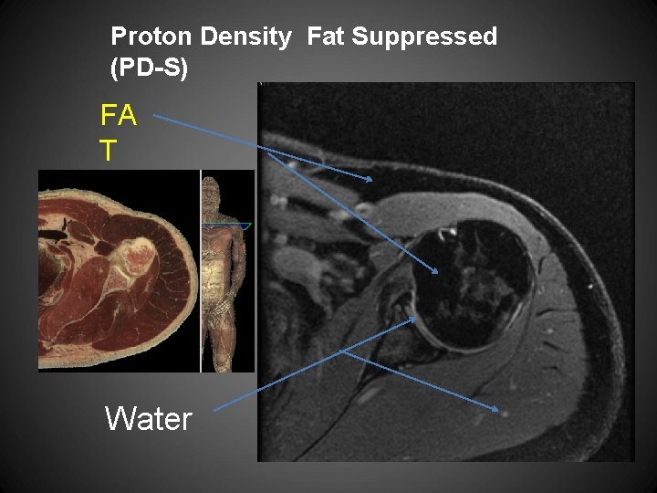 Proton Density Fat Suppressed (PD-S) FA T Water 