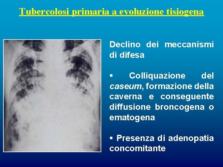 Tubercolosi primaria a evoluzione tisiogena Declino dei meccanismi di difesa § Colliquazione del caseum,