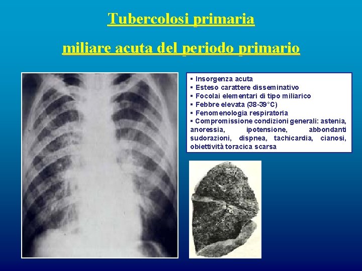 Tubercolosi primaria miliare acuta del periodo primario § Insorgenza acuta § Esteso carattere disseminativo