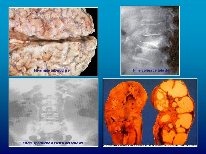 Meningite tubercolare Lesioni specifiche a carico del rene dx Tubercolosi vertebrale 