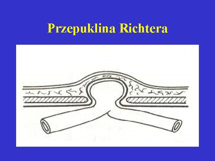 Przepuklina Richtera 