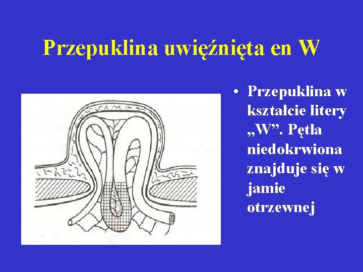 Przepuklina uwięźnięta en W • Przepuklina w kształcie litery „W”. Pętla niedokrwiona znajduje się