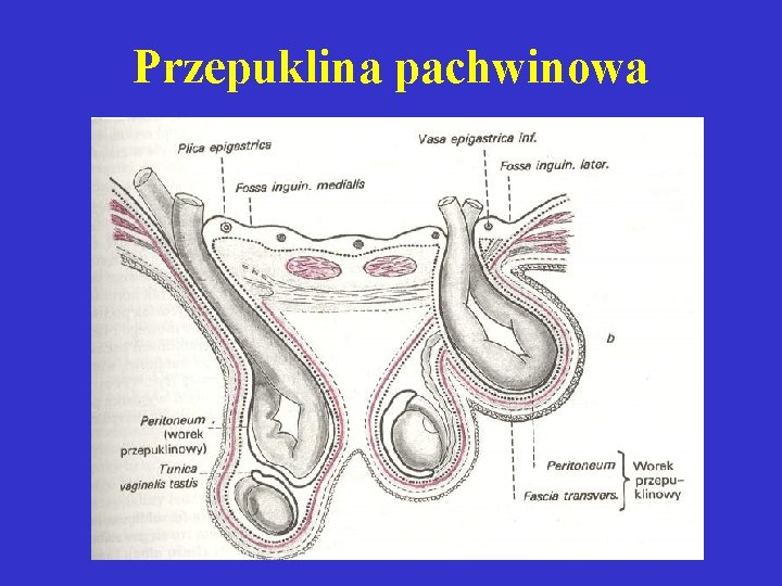 Przepuklina pachwinowa 