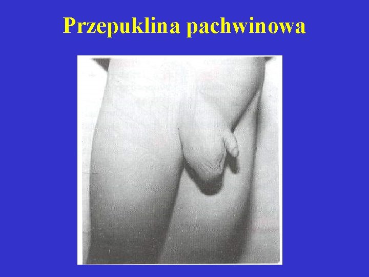 Przepuklina pachwinowa 