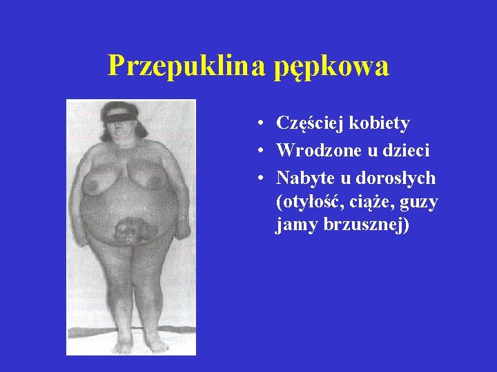 Przepuklina pępkowa • Częściej kobiety • Wrodzone u dzieci • Nabyte u dorosłych (otyłość,