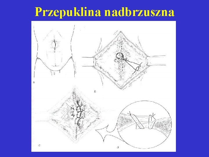 Przepuklina nadbrzuszna 