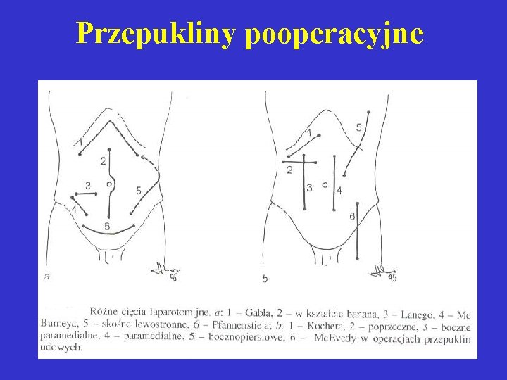 Przepukliny pooperacyjne 