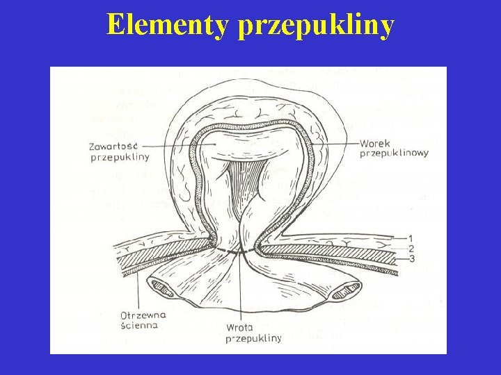 Elementy przepukliny 