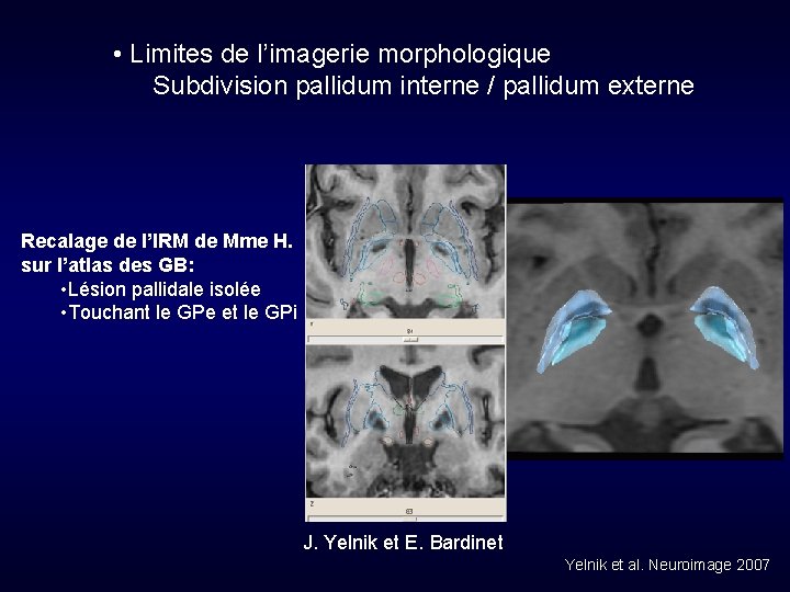  • Limites de l’imagerie morphologique Subdivision pallidum interne / pallidum externe Recalage de