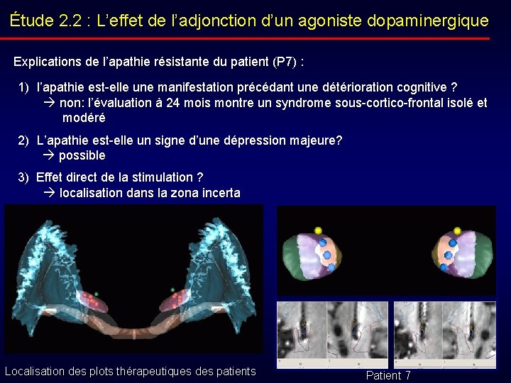 Étude 2. 2 : L’effet de l’adjonction d’un agoniste dopaminergique Explications de l’apathie résistante