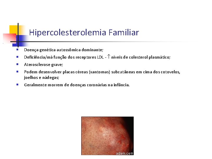 Hipercolesterolemia Familiar Doença genética autossômica dominante; Deficiência/má função dos receptores LDL - níveis de