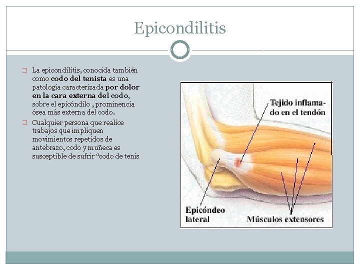 Epicondilitis � La epicondilitis, conocida también como codo del tenista es una patología caracterizada