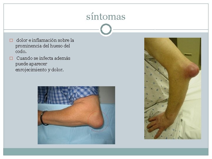 síntomas � dolor e inflamación sobre la prominencia del hueso del codo. � Cuando