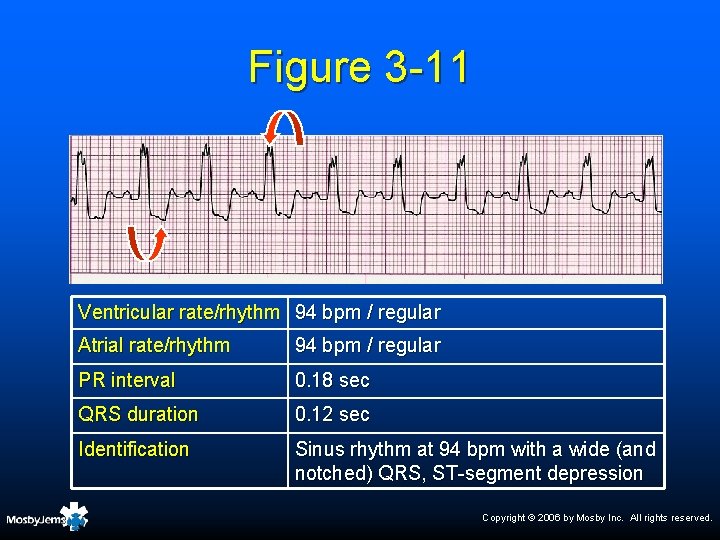 Figure 3 -11 Ventricular rate/rhythm 94 bpm / regular Atrial rate/rhythm 94 bpm /