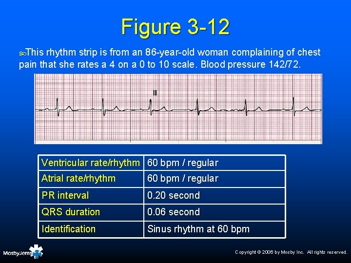 Figure 3 -12 This rhythm strip is from an 86 -year-old woman complaining of