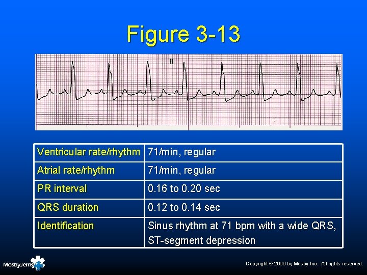 Figure 3 -13 Ventricular rate/rhythm 71/min, regular Atrial rate/rhythm 71/min, regular PR interval 0.