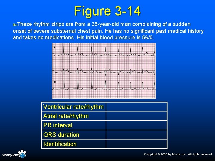 Figure 3 -14 These rhythm strips are from a 35 -year-old man complaining of