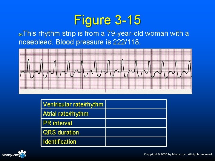 Figure 3 -15 This rhythm strip is from a 79 -year-old woman with a