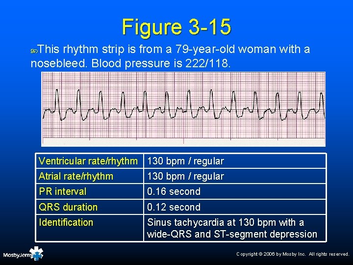 Figure 3 -15 This rhythm strip is from a 79 -year-old woman with a