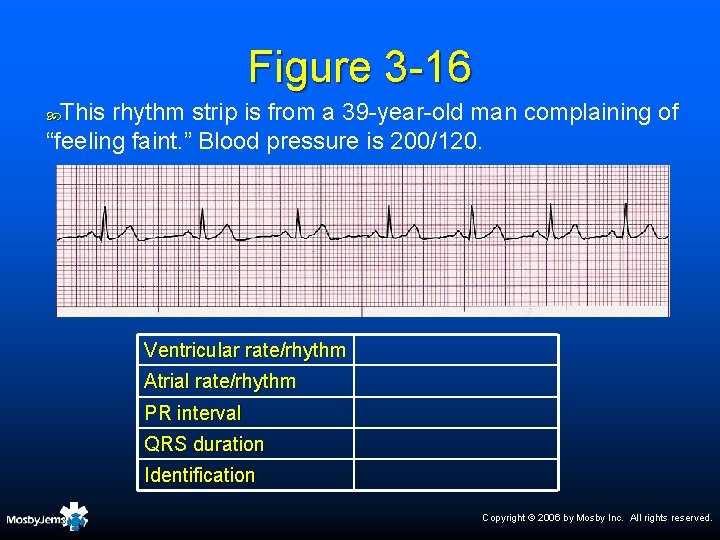Figure 3 -16 This rhythm strip is from a 39 -year-old man complaining of