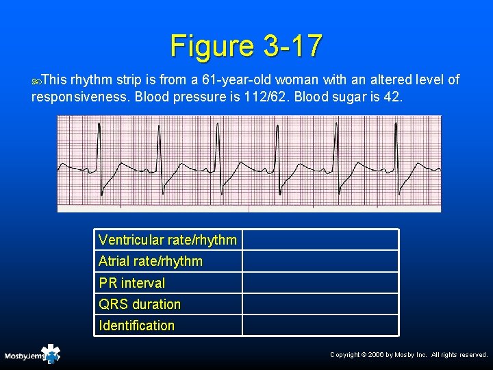 Figure 3 -17 This rhythm strip is from a 61 -year-old woman with an