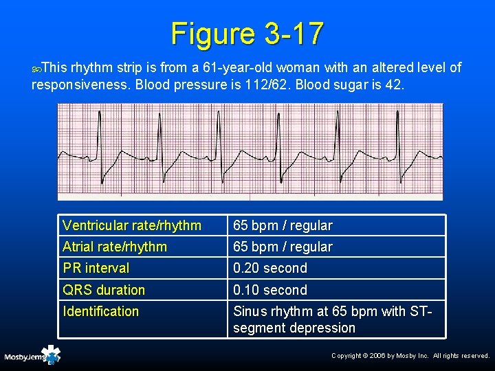 Figure 3 -17 This rhythm strip is from a 61 -year-old woman with an