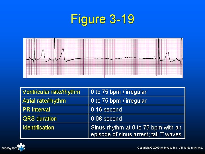 Figure 3 -19 Ventricular rate/rhythm 0 to 75 bpm / irregular Atrial rate/rhythm 0