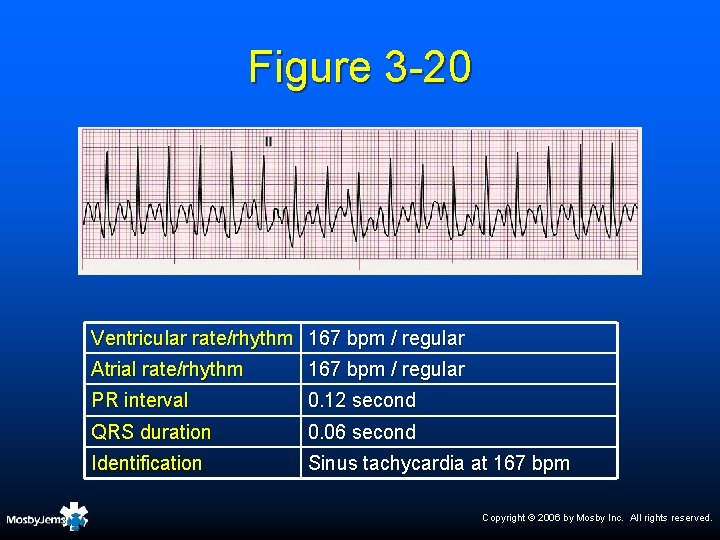 Figure 3 -20 Ventricular rate/rhythm 167 bpm / regular Atrial rate/rhythm 167 bpm /