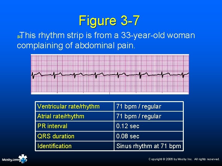 Figure 3 -7 This rhythm strip is from a 33 -year-old woman complaining of
