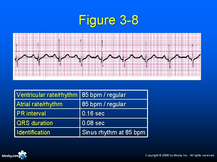 Figure 3 -8 Ventricular rate/rhythm 85 bpm / regular Atrial rate/rhythm 85 bpm /