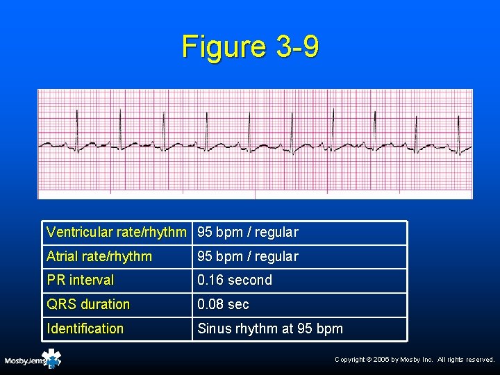 Figure 3 -9 Ventricular rate/rhythm 95 bpm / regular Atrial rate/rhythm 95 bpm /