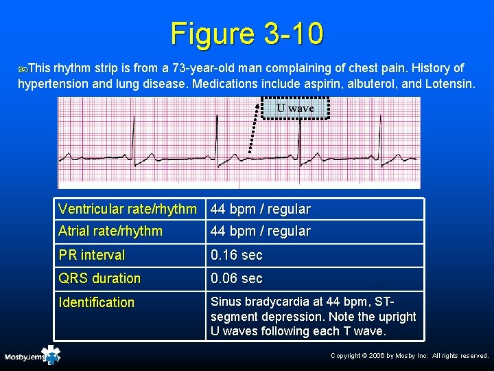 Figure 3 -10 This rhythm strip is from a 73 -year-old man complaining of