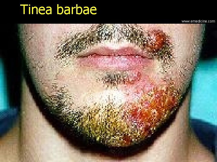 Tinea barbae www. emedicine. com 