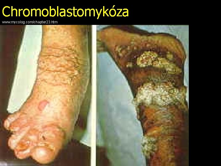 Chromoblastomykóza www. mycolog. com/chapter 23. htm 