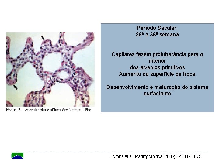 Período Sacular: 26ª a 36ª semana Capilares fazem protuberância para o interior dos alvéolos