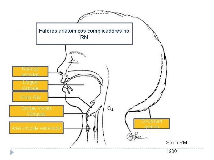 Fatores anatômicos complicadores no RN Narinas estreitas Lingua Grande Glote Alta Cordas Vocais Obliquas