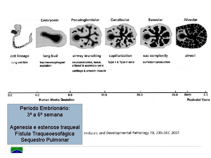 Período Embrionário: 3ª a 6ª semana Agenesia e estenose traqueal Fístula Traqueoesofágica Sequestro Pulmonar