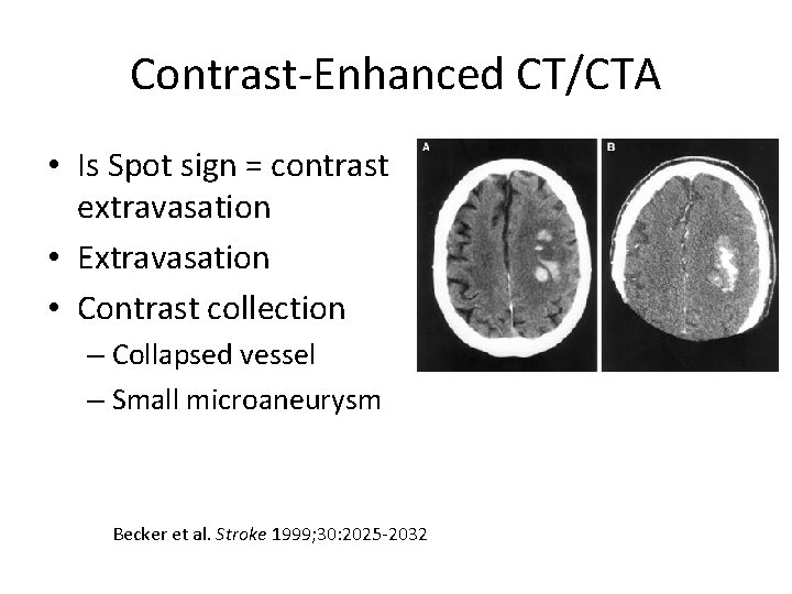Contrast-Enhanced CT/CTA • Is Spot sign = contrast extravasation • Extravasation • Contrast collection