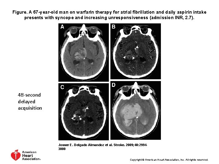 Figure. A 67 -year-old man on warfarin therapy for atrial fibrillation and daily aspirin