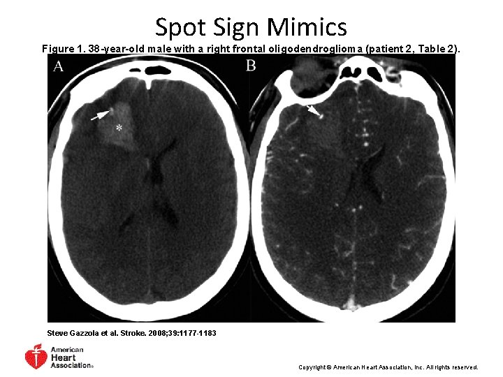 Spot Sign Mimics Figure 1. 38 -year-old male with a right frontal oligodendroglioma (patient