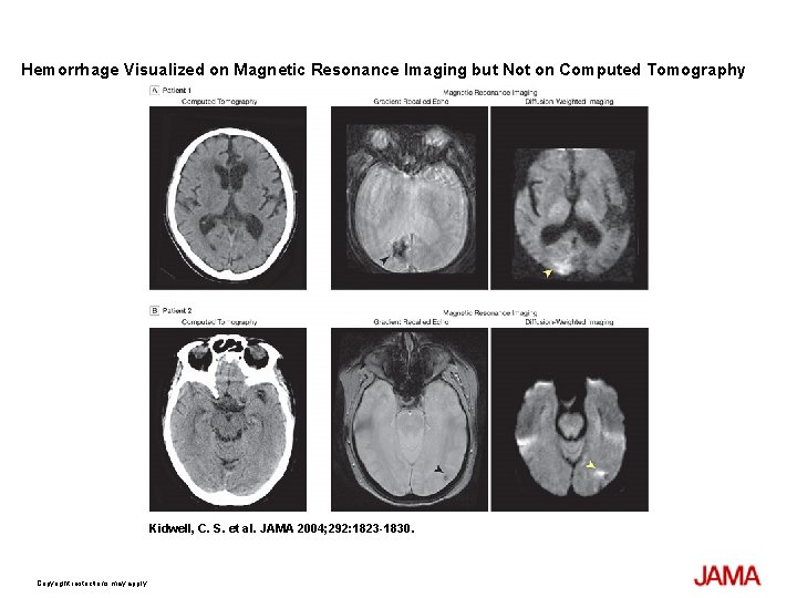 Hemorrhage Visualized on Magnetic Resonance Imaging but Not on Computed Tomography Kidwell, C. S.