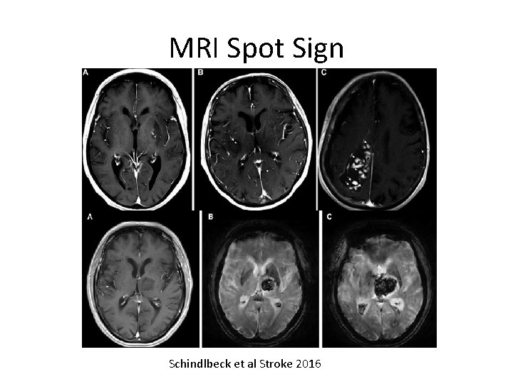 MRI Spot Sign Schindlbeck et al Stroke 2016 