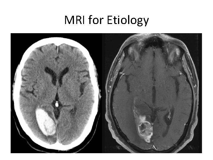 MRI for Etiology 