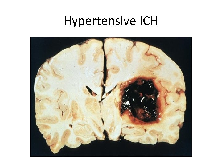 Hypertensive ICH 