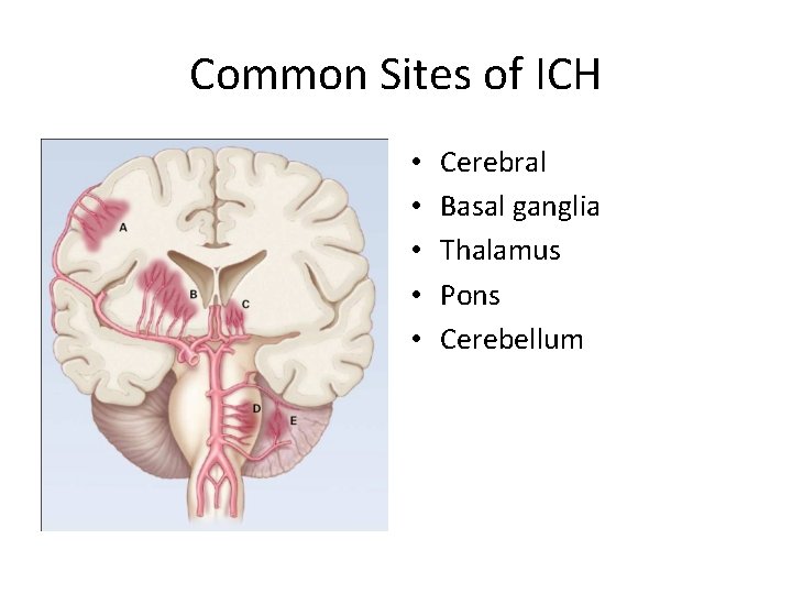 Common Sites of ICH • • • Cerebral Basal ganglia Thalamus Pons Cerebellum 