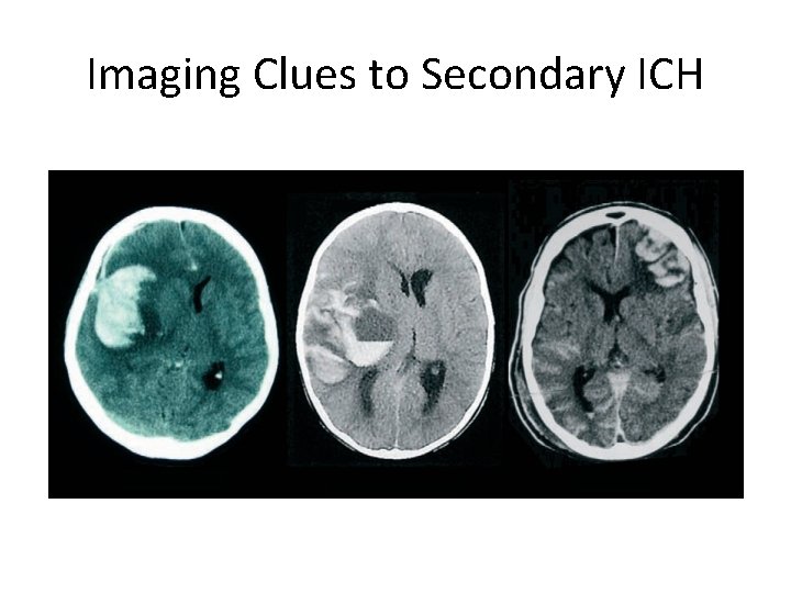 Imaging Clues to Secondary ICH 