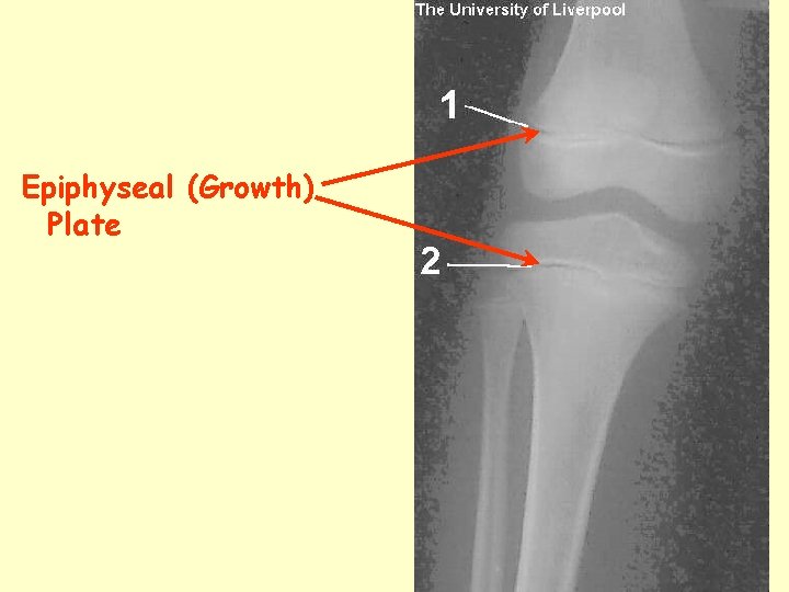 Epiphyseal (Growth) Plate 